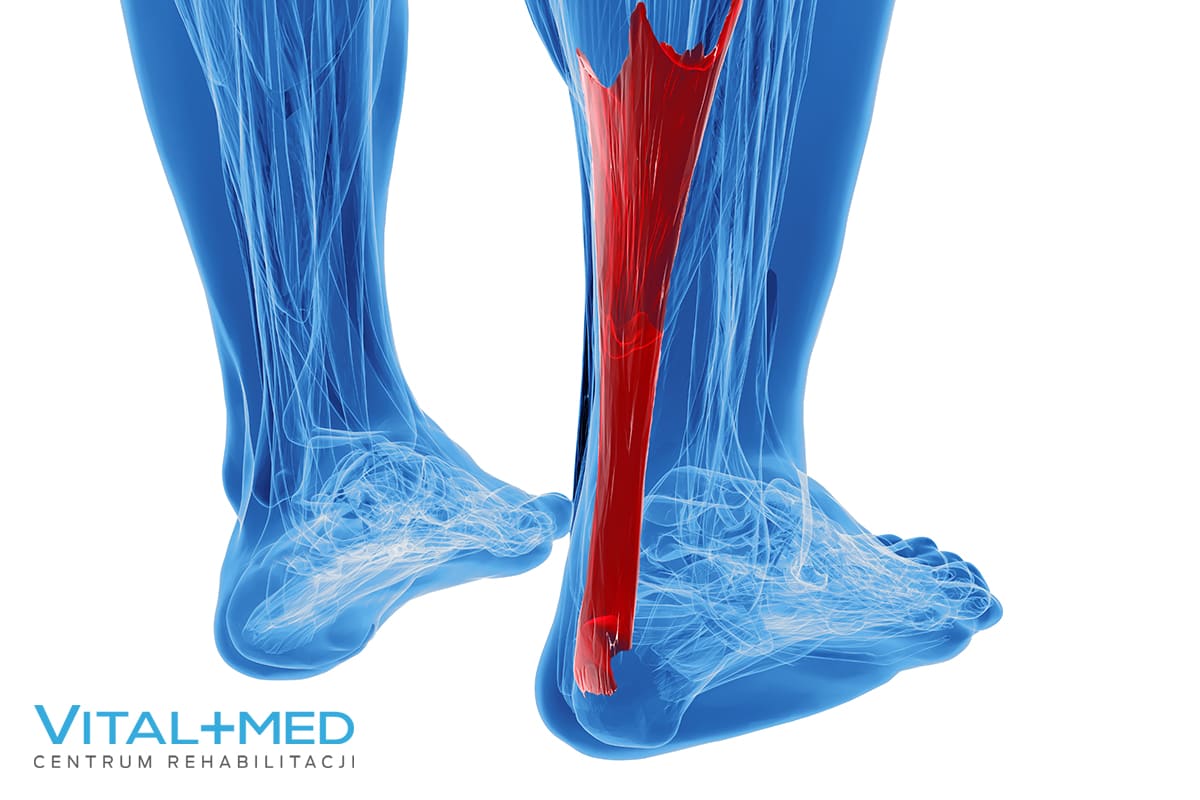 ból łydki svg+xml,%3Csvg%20xmlns%3D'http%3A%2F%2Fwww.w3