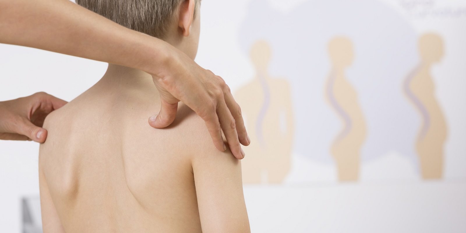 Skolioza u dzieci Przyczyny, objawy, leczenie