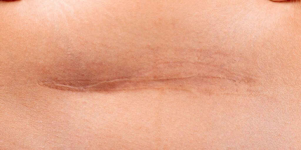 Cesarean section close up svg+xml,%3Csvg%20xmlns%3D'http%3A%2F%2Fwww.w3