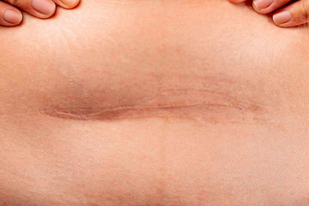 Cesarean section close up svg+xml,%3Csvg%20xmlns%3D'http%3A%2F%2Fwww.w3